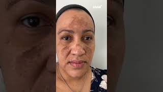 Get beautiful skin without dark spots by using Renewal Face Cream darkspots darkspotsolution [upl. by Iohk]