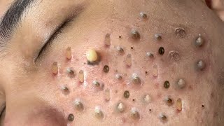 ACNE TREATMENT VU QUYNH MI Blackheads Removal Popping [upl. by Eidas]