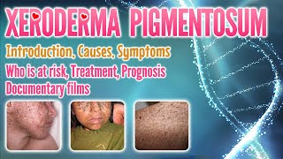 Xeroderma pigmentosum causes symptoms treatment prognosis documentary pronunciation  XP [upl. by Simpkins]