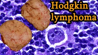 Hodgkin lymphoma  Simply Explained Symptoms causes prognosis treatment [upl. by Bethezel]