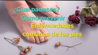 ¿Cuales son las dolencias más comunes de los pies [upl. by Rodina]