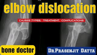 ELBOW DISLOCATION diagnosis causes treatment Drprasenjit dattabone doctor [upl. by Wager189]