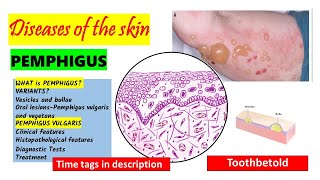 Pemphigus Vulgaris Pathogenesis clinical features oral manifestations  Pemphigus Variants PART 1 [upl. by Mortimer]