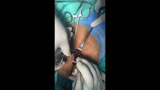 Peritoneal Catheter insertion by open technique Part II [upl. by Sipple]