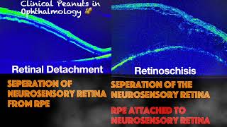 Retinoschisis Vs Retinal Detachment [upl. by Bowers120]