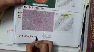 granulomatous thyroiditis  Pathology [upl. by Anayi968]