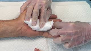 Left Ring Finger Xiaflex Injection and Manipulation for Dupuytrens Disease Contracture [upl. by Kir]