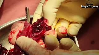 Ectopic Pregnancy Laparotomy 02 03 2024 [upl. by Rieger]