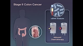 ctDNAGuided Therapy in Stage II Colon Cancer  NEJM [upl. by Aihsetal853]