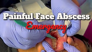 We Drain a Painful Facial Abscess in a Teenager [upl. by Dorelia]