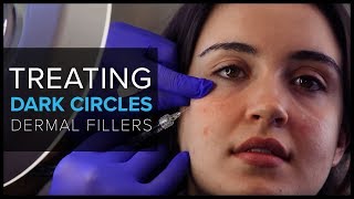 Treating Dark UnderEye Circles With Dermal Fillers at Mabrie Facial Institute [upl. by Barris18]