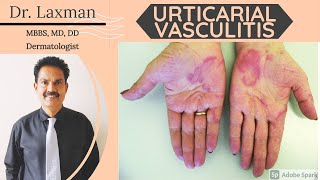 Urticarial Vasculitis  Vasculitis  Causes amp Symptoms amp Treatment Vasculitis Allergy Dermatology [upl. by Rosa]