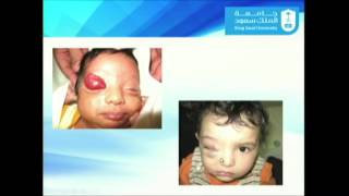 Update in Orbital and Periorbital and Hemangiomas and Vascular Malformation [upl. by Aronid]