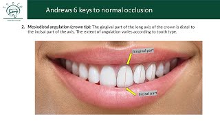 Andrews six keys to normal occlusion lesson 2 2nd 4th 5th keys [upl. by Eniotna342]