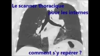 Les bronches en scanner pour les internes [upl. by Lodnar]