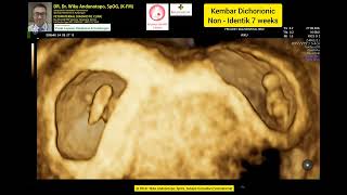 7 Weeks Dichorionic Twins [upl. by Nimajeb]