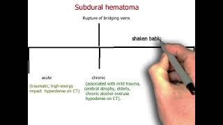 Subdural hematoma neurology 81  First Aid USMLE Step 1 in UrduHindi [upl. by Linzer]