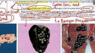 Biliary Atresia Cholelithiasis from first aid step 1USMLEUrduHindi [upl. by Ecissej]