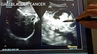 GALLBLADDER CANCER I GB CARCINOMA I GB ADENOCARCINOMA I GB MALIGNANCY I GB MASS I [upl. by Hpotsirhc120]