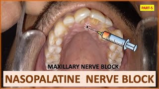 NASOPALATINE NERVE BLOCK PART5 MAXILLARY NERVE BLOCK ORAL SURGERY dentalcafe4331 [upl. by Elfrida]