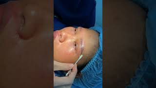 wenkbroue lig laer ooglid chirurgie krimp die philtrum xuhuongyoutube lamdep thongthainguyen [upl. by Vasya768]