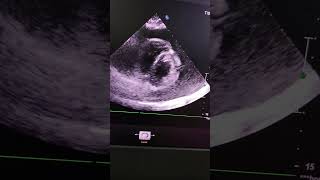 Massive Pericardial EffusionSwinging Heart Sign Clinical Pearl4 [upl. by Cath80]