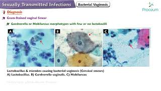 Bacterial Vaginosis Etiology Clinical Features Diagnosis Treatment [upl. by Olvan]