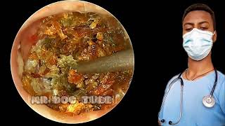 🔴very big ear cholesteatoma remove from ear canalearearwax earwaxremovalearwaxcleaningasmr [upl. by Ellevehs785]