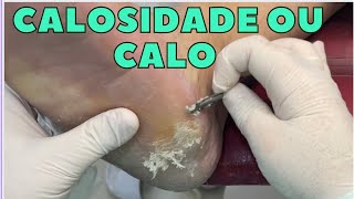 Calos ou Calosidade Podologia 2022 calluses on feet [upl. by Yunfei654]