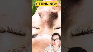 ULTIMATE PORE STRIP REMOVAL  How To Prep Skin For Pore Strips shorts [upl. by Emmalynn39]