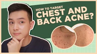 Get rid of CHEST amp BACK ACNE BEST PRODUCTS  DOs and DONTs Filipino  Jan Angelo [upl. by Jilly]