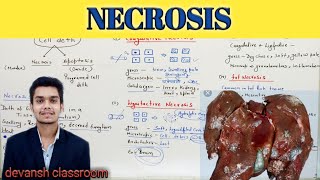 NECROSIS  cell injury  general Pathology Hindi [upl. by Auohp]