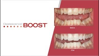 StepbyStep Opalescence Boost Teeth Whitening Procedure  Australia [upl. by Fiertz760]