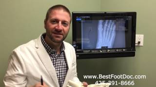 Tailors Bunion  Treatments and Information [upl. by Kiele]