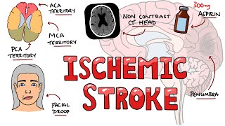 Acute Ischemic Stroke  Signs and Symptoms Stroke Syndromes  Causes amp Mechanisms  Treatment [upl. by Atled693]