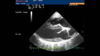 Echocardiography right parasternal longaxis view showing [upl. by Aroved]