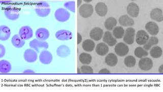 24 Practical Parasitology  Plasmodium Falciparum  Ring Stage [upl. by Nanyt]