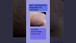 urtica urens homeopathic medicine usesurticaria treatmenturticaria medical homoeopathyurticaria [upl. by Atsira]