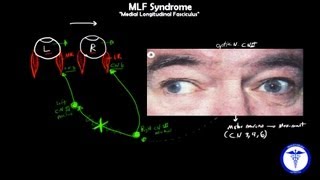 MLF syndrome  Internuclear Ophthalmoplegia MADE EASY [upl. by Anitsyrhc]