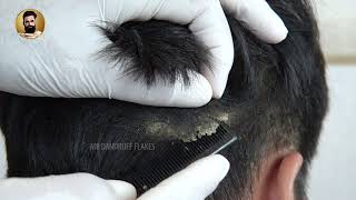 Combing Out Dandruff Black Hair Dandruff Removal ​297 [upl. by Giglio]