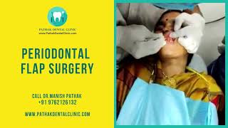 Periodontal Flap Surgery  Pathak Dental Clinic Pimpri Chinchwad Pune [upl. by Ellivro]