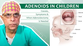 Adenoids in Children Causes Symptoms amp When Adenoidectomy is Needed  Dr Major Rajesh Bhardwaj [upl. by Narayan]