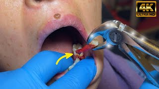 Abscessed Tooth Extraction in 1 MIN or less in 4K [upl. by Basilius]