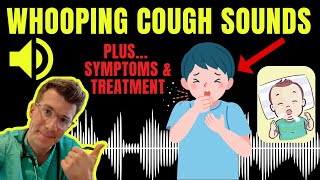 Doctor explains WHOOPING COUGH plus examples of REAL SOUNDS  Symptoms diagnosis treatment amp more [upl. by Kariotta]