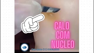 CALO MUITO DOLORIDO O TRATAMENTO COM PODOLOGA [upl. by Eleonore593]