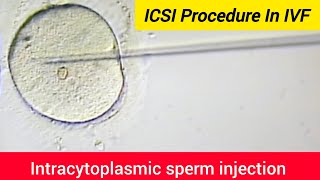 ICSI Procedure in IVF  Intracytoplasmic sperm injection  Assisted Reproductive Technology ICSI [upl. by Yurt]