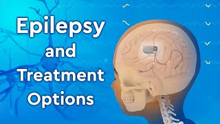 What is Epilepsy and How is it Treated [upl. by Cogan]