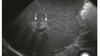 Case 0088 biliary atresia [upl. by Isej]