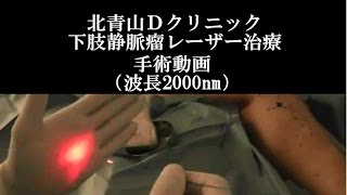 下肢静脈瘤2000nmレーザー手術動画【北青山Ｄクリニック】 [upl. by Tinor]