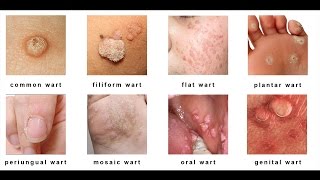 Warts on Skin  Types Causes and Home Remedies for Skin Warts [upl. by Ettolrahs]